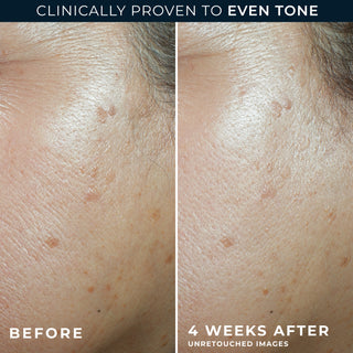 MULTI CORREXION® Even Tone + Lift Daily Moisturizer SPF 30 Before and after of participant's cheek showing visibly smoother skin tone