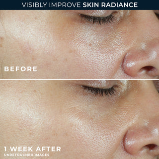 Before and After Image of clinical study participant showing improvement in the texture of skin on cheek after using MULTI CORREXION® Revive + Glow Moisturizer SPF 30 for 1 week.