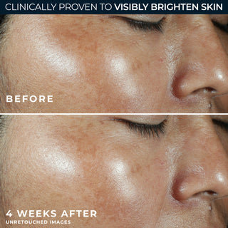 Before and After Image of clinical study participant showing improvement in the texture of skin on cheek after using MULTI CORREXION® Revive + Glow Moisturizer SPF 30 for 4 week.