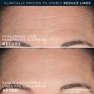 clinically proven to visibly reduce lines
hyaluronic acid penetrates 10 layers
before
skin is smoother & lines are replumped
after
photos to demonstrate purpose only