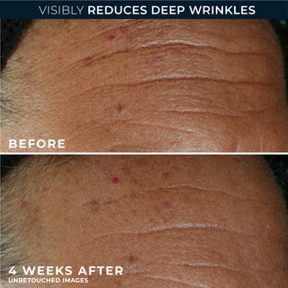 Before and after photos
Visibly reduces deep wrinkles
before
4 weeks after unretouched images