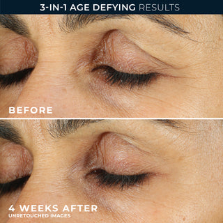 Before and after 4 weeks eye image for retinol correction line smoothing eye cream: experience 3-in age defying results. all images are unretouched. 