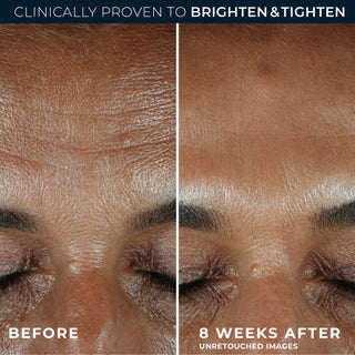 MULTI CORREXION® Revive and Glow Daily Serum Before and After image of customer forhead showing improved skin appearance after 8 weeks of use 
clinically proven to brighten & tighten