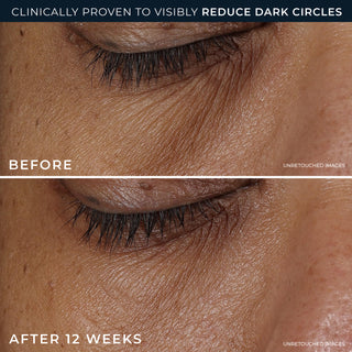 clinically proven to visibly reduce dark circles
before and after 12 weeks
unretouched images