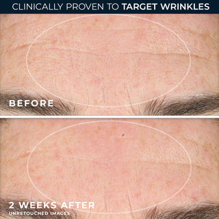 Unretouched before and after comparison images showing forehead wrinkles after 2 weeks.