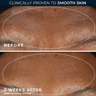 Unretouched before and after comparison images showing forehead wrinkles after 2 weeks.