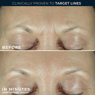Before and after comparison of eye area skin texture with text indicating clinical provenance and time saved.