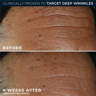 Before-and-after split-screen comparison of a person's forehead showing the reduction in deep wrinkles after 4 weeks of use, with text overlays reading 'BEFORE' and '4 WEEKS AFTER' and a top banner stating 'CLINICALLY PROVEN TO TARGET DEEP WRINKLES'.
