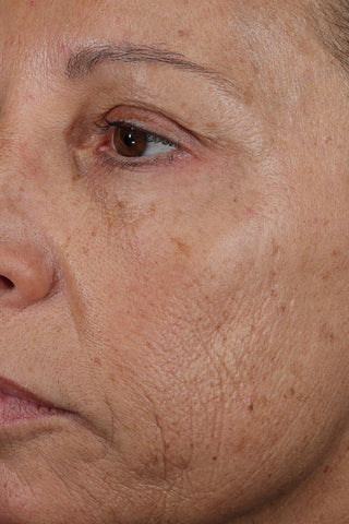 Close-up of a person's face showing the cheek, eye, nose, and mouth area with visible skin texture, freckles, and wrinkles.
