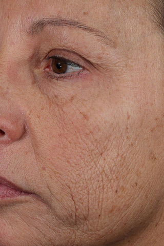 Close-up of a woman's face showing skin texture, wrinkles, and sun damage around the eye and cheek.