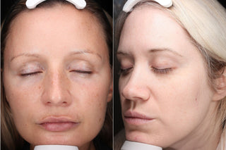 before of two different patients for the roc 35 protocol clinical trial