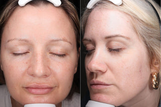 after 30 / 90 days of two different patients for the roc 35 protocol clinical trial