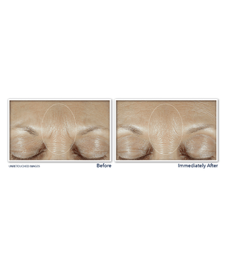 Before and after image of participant's forehead showing reduction in fine lines between eyebrows after one use of DERM CORREXION® Fill + Treat Serum