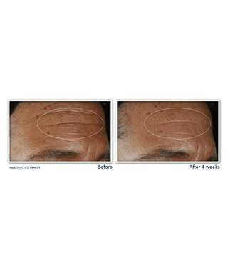 Before and after image of participant's forehead showing reduction in horizontal fine lines  after using DERM CORREXION® Fill + Treat Serum for 4 weeks.