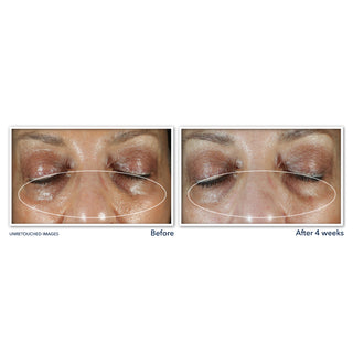 MULTI CORREXION® Even Tone + Lift Eye Cream Before and after image of participant's eye area showing a visible reduction in under eye darkness.