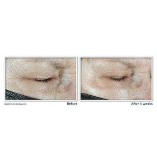 Before and after image of study participant eye area showing reduction of fine lines after 4 weeks of use of MULTI CORREXION® Hydrate + Plump Eye Cream