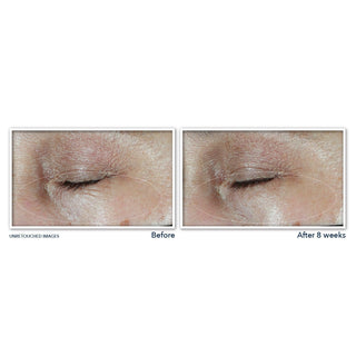 Before and after image of study participant eye area showing reduction of undereye lines after 8 weeks of use of MULTI CORREXION® Hydrate + Plump Eye Cream