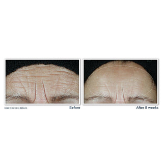 Before and After image of study participant forehead showing visibly smoother skin on forehead after 4 weeks of use of MULTI CORREXION® Hydrate + Plump Moisturizer with SPF 30