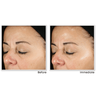 MULTI CORREXION® Revive and Glow Daily Serum before and after image of customer side profile to show improved appearance of skin radiance immediately after using serum