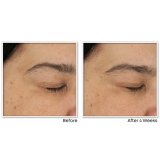 MULTI CORREXION® Revive + Glow Moisturizer before and after image of customer with smoother brighter skin tone on upper cheek after 4 weeks of use
