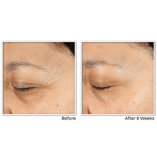 MULTI CORREXION® Revive and Glow Daily Serum Before and After image of customer upper cheek and forehead showing improved skin appearance after 8 weeks of use 