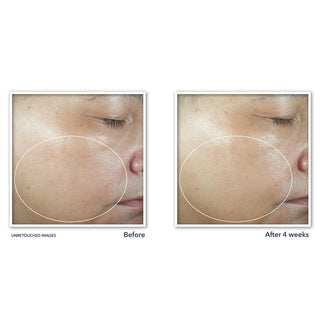 MULTI CORREXION® Even Tone + Lift Resurfacing Serum Before and after image of participant cheek showing more even skin tone on cheek after 4 weeks of use
