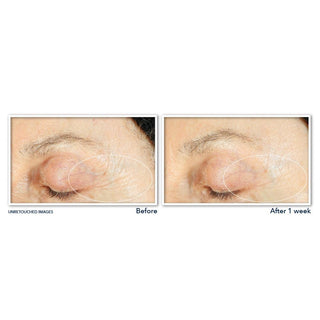Before and After 1 week unretouched images of the eye area