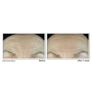 Before and after 1 week unretouched images of the forehead area.