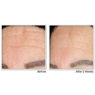 MULTI CORREXION® Revive + Glow Gel Cleanser before and after images of customer forehead showing smoother skin after 2 weeks of use