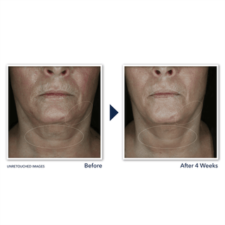Before and After images of study participant showing visibly firmer skin  of neck and jowl after 4 weeks of use