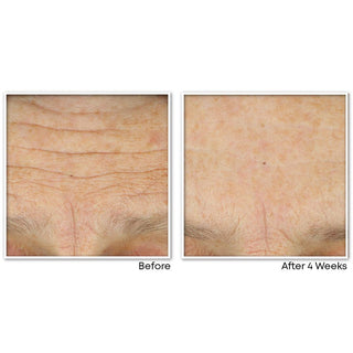 Before and After image showing reduced lines on study participant forehead after 4 weeks of using MULTI CORREXION® Crépe Repair Face & Neck Cream