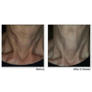 Before and After image showing reduced lines on study participant neck after 8 weeks of using MULTI CORREXION® Crépe Repair Face & Neck Cream